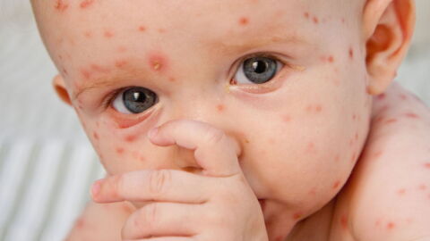 Chickenpox: Symptoms, Contagiousness, And Treatment