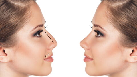 Everything You Need To Know About Rhinoplasty