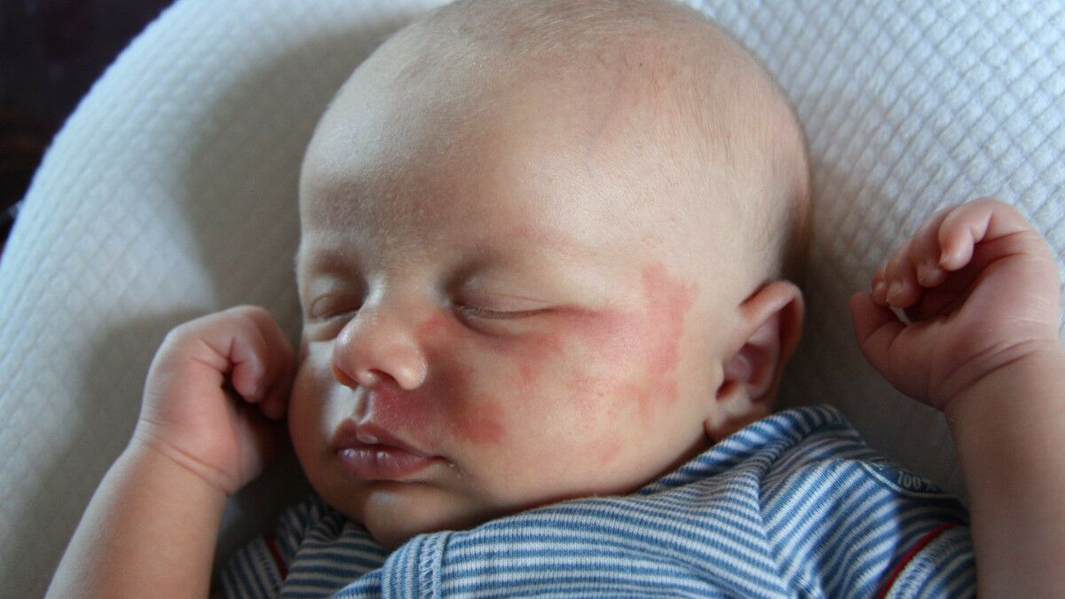 Everything You Need To Know About Vascular Birthmarks In Babies