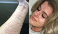 This Woman Has A Rare Allergy That Could Kill Her Every Time She Steps Outside