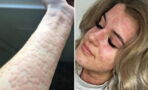 This Woman Has A Rare Allergy That Could Kill Her Every Time She Steps Outside