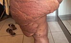 This Woman's Leg Won't Stop Growing And It's Ruining Her Life