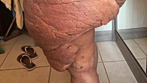 This Woman's Leg Won't Stop Growing And It's Ruining Her Life