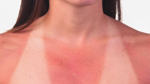 This Is The Real Reason That Sunburn Turns Your Skin Red