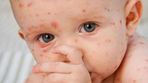 Symptoms, Duration And Treatment: Chickenpox In Children