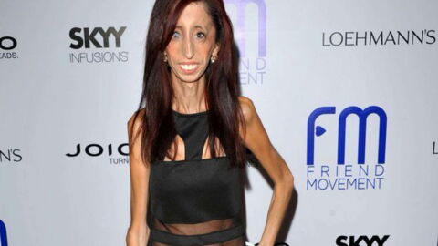 Everything You Need To Know About Marfan Syndrome