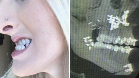 She Was Bullied Because Of Her Jaw As A Kid But Now She’s Absolutely Stunning