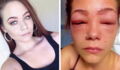 She almost lost her sight after trying to dye her eyebrows