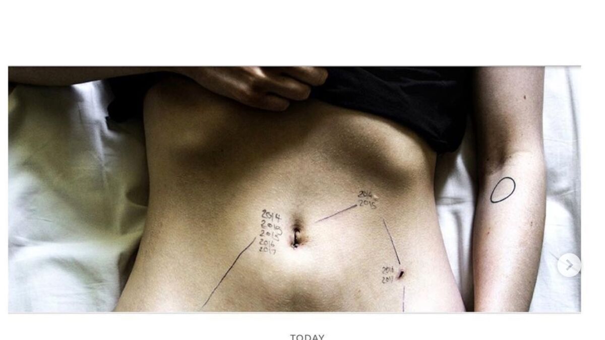 Endometriosis tattoo  Download Scientific Diagram