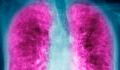 Lung cancer in women: seven symptoms to watch out for