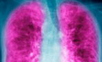 Lung cancer in women: seven symptoms to watch out for