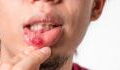 Cold sores: Why you often get mouth sores or canker sores