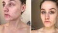 This Woman Stopped Washing Her Face For Six Months And Cured Her Acne