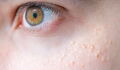 Milia: what causes these small white dots under your eyes?