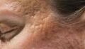 Atrophic scarring: What it is and how to treat it