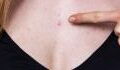 Chest acne: Why we get it and how to get rid of it