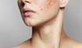 Acne: Could this superfood be the cure?