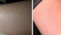 Keratosis pilaris: This is what causes those little red dots on your skin