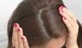 Dandruff: Here's what your flakes say about your scalp condition