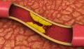 What is venous thrombosis, and do COVID vaccines cause it?