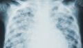 COVID pneumonia: Most common symptoms to watch out for