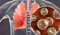 Another outbreak of a potentially fatal fungal infection causes alarm, here are the symptoms