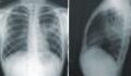 COVID: X-rays reveal 'shocking difference' in lungs of vaccinated and unvaccinated patients