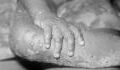 Monkeypox: The signs and symptoms of the virus detected in the UK