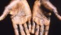Monkeypox: WHO recommends Covid-19 measures to contain the virus