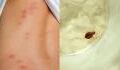 Paris Bed Bug infestation: How to tell the difference between theirs and mosquito bites?