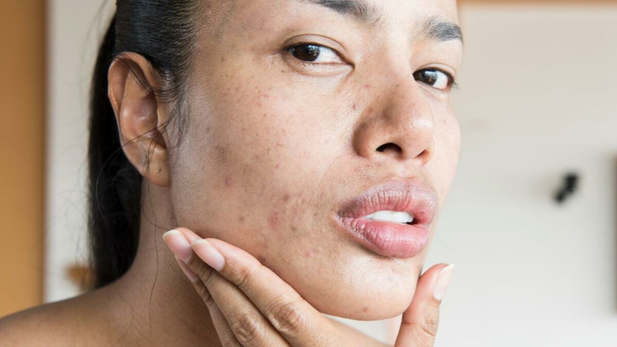 Understanding What Triggers Hormonal Acne And How To Treat It