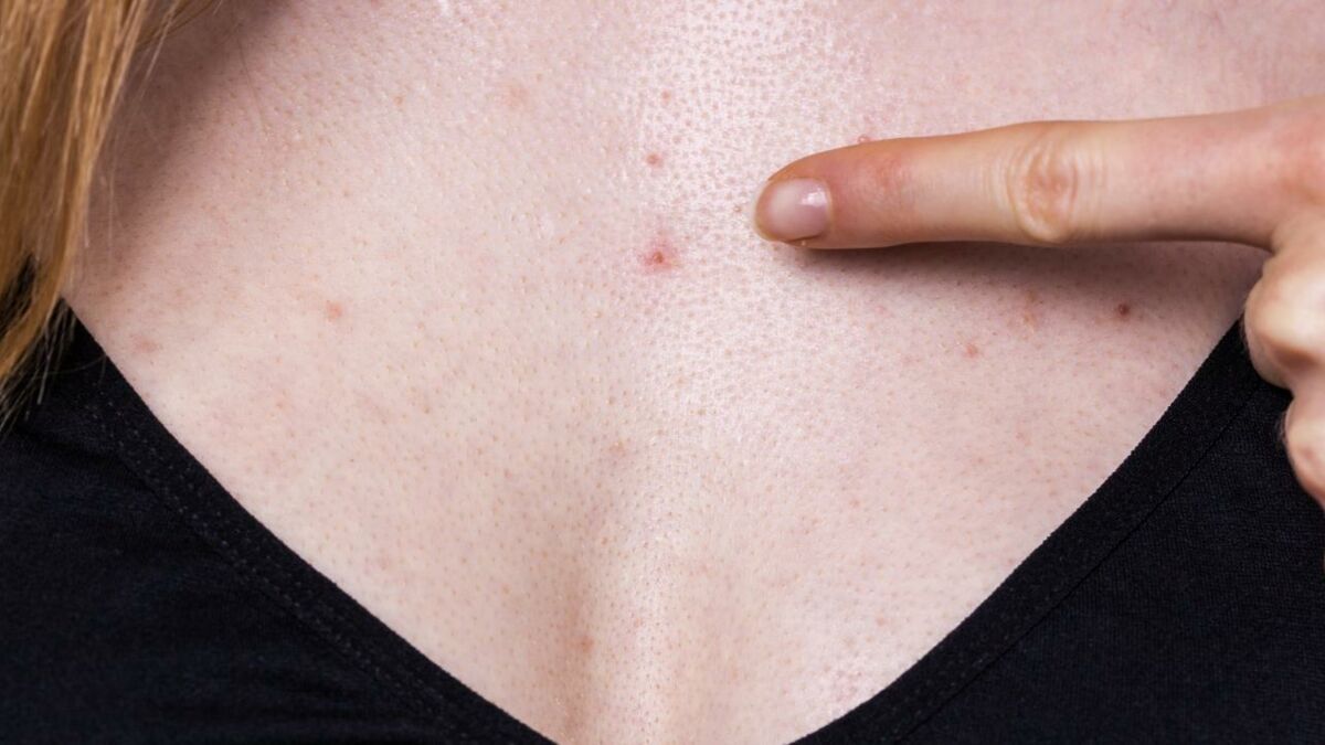 Chest acne: Why we get it and how to get rid of it