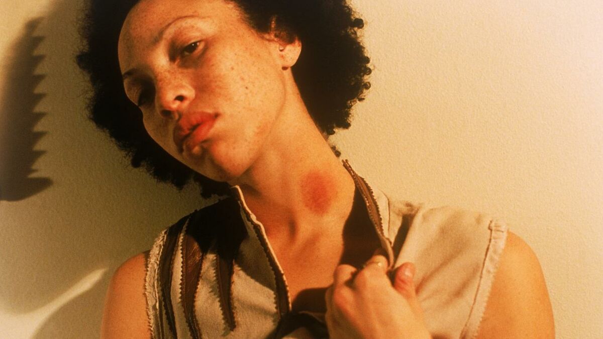 Six ways to get rid of a hickey that actually work — and two that dont photo image