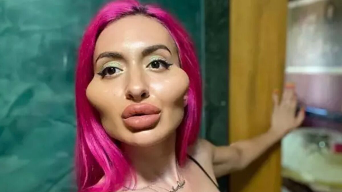 After Injecting Fillers into Her Own Face This Woman Claims She Get&a… 