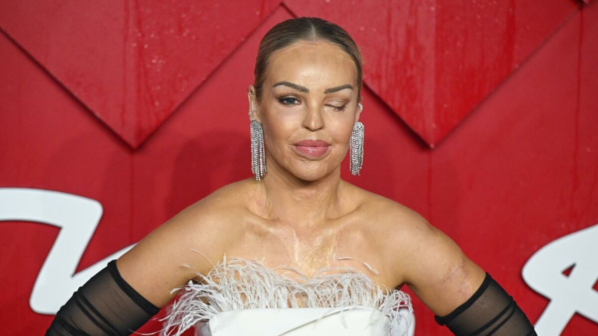 Katie Piper How long will her eye stay sewn shut and why did she