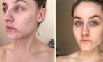 This Woman Stopped Washing Her Face For Six Months And Cured Her Acne