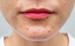 Cystic acne: What it is and how to treat it