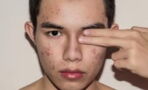 What causes acne?
