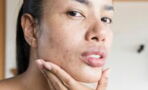 Understanding what triggers hormonal acne and how to treat it