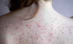 Everything you need to know about back acne