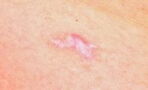 Hypertrophic scars explained: Why they occur and how to treat them