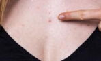 Chest acne: Why we get it and how to get rid of it