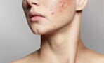 Acne: Could this superfood be the cure?