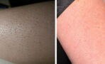 Keratosis pilaris: This is what causes those little red dots on your skin