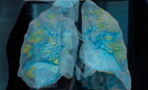 How the coronavirus affects the lungs can be seen for the first time in this video