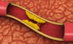 What is venous thrombosis, and do COVID vaccines cause it?