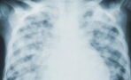COVID pneumonia: Most common symptoms to watch out for