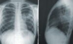 COVID: X-rays reveal 'shocking difference' in lungs of vaccinated and unvaccinated patients