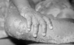 Monkeypox: The signs and symptoms of the virus detected in the UK