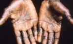 Monkeypox: WHO recommends Covid-19 measures to contain the virus